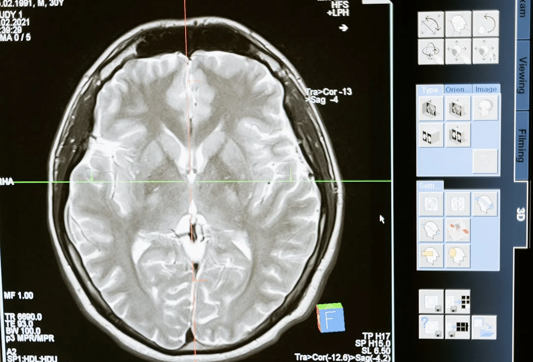 A computer screen displaying a brain scan